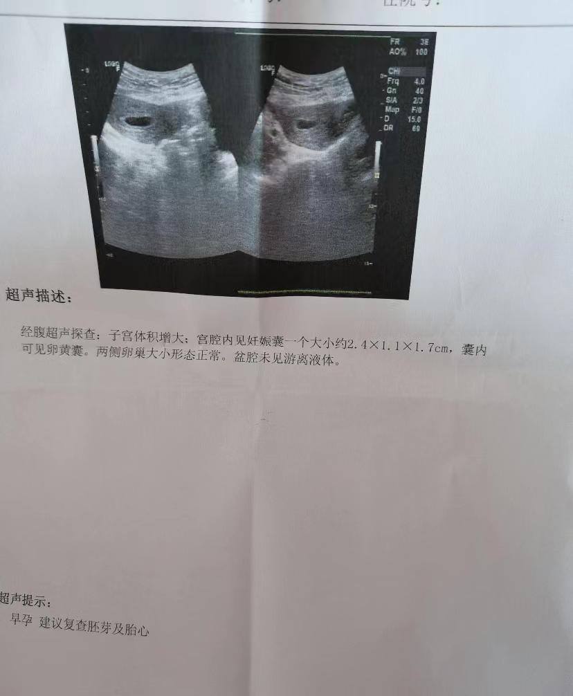 人流手术怎么操作过程现在月经正常来了