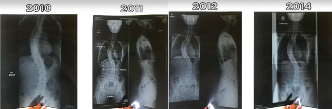 比杨幂驼背更吓人的竟是唐艺昕的脊椎侧弯