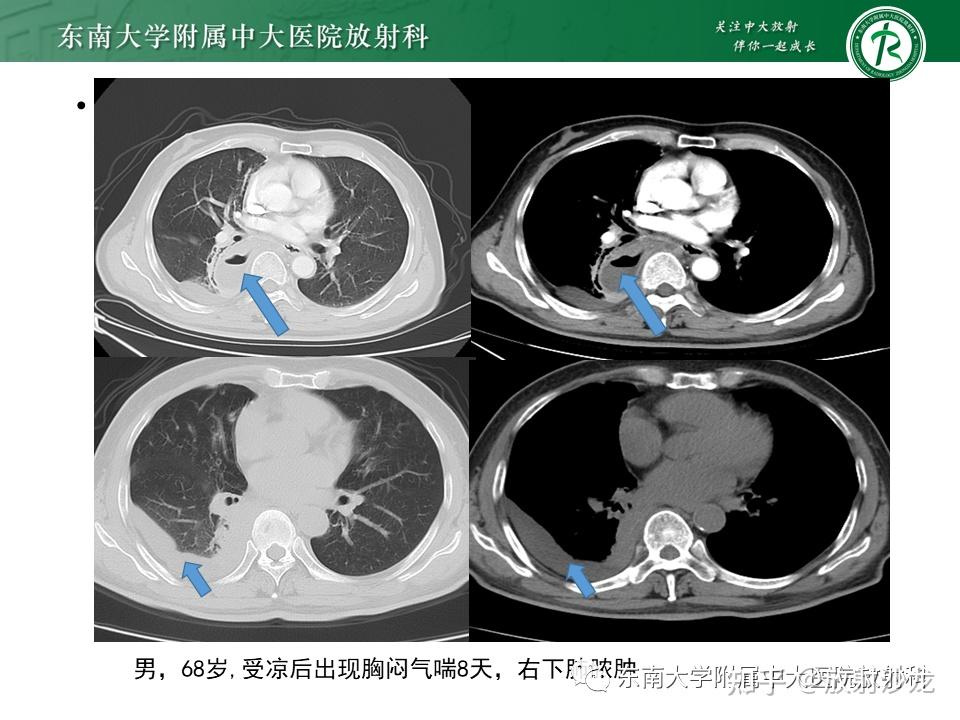 肺隔离症图片图片