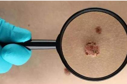 hpv51怎么引起的