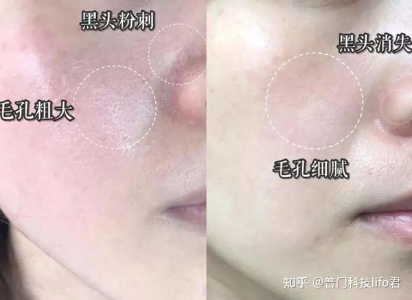 亲测 || 一款专业的红蓝黄光治疗仪器能给皮肤带来哪些改变？ - 知乎