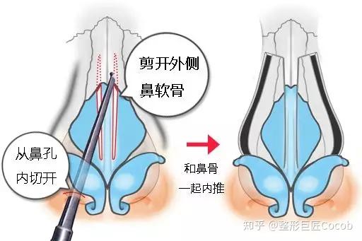 中央就有一鼓包~傳統的去駝峰比較簡單,就是直接削掉突出的位置就可以