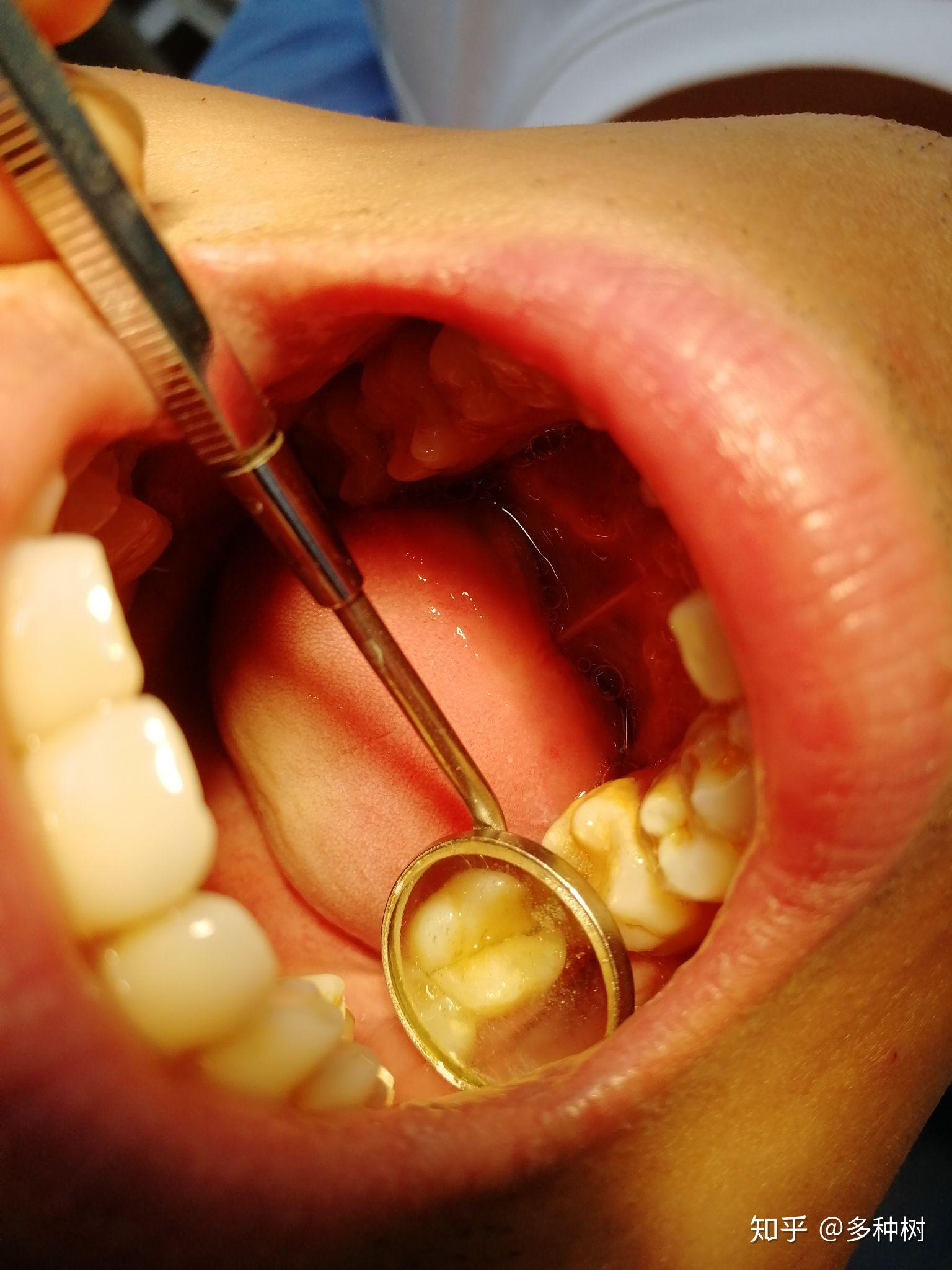 把牙神经杀掉有什么后果建议杀掉做一颗烤瓷牙吗