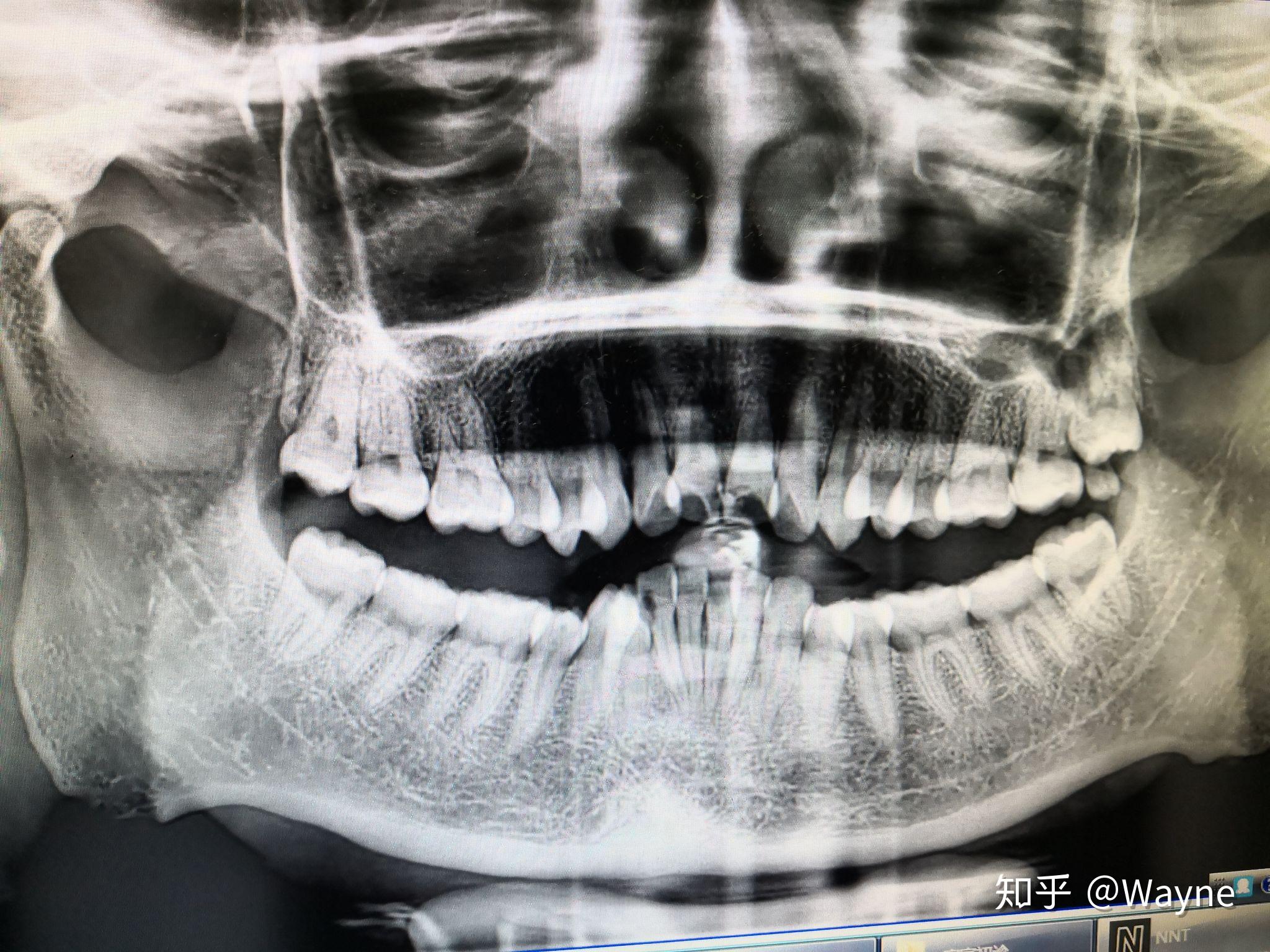 拜博拍片,结论:牙性外凸20191012然后费用,非自锁预计2万,自锁两万五.