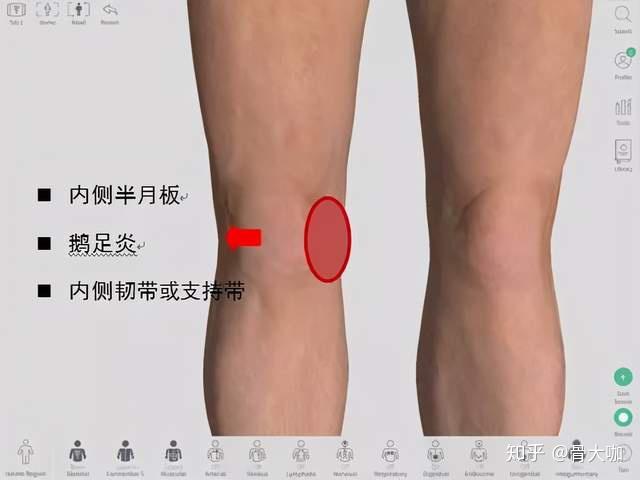膝盖内侧疼痛可能是因为:①鹅足炎:常发生在跑步运动爱好者身上,鹅足