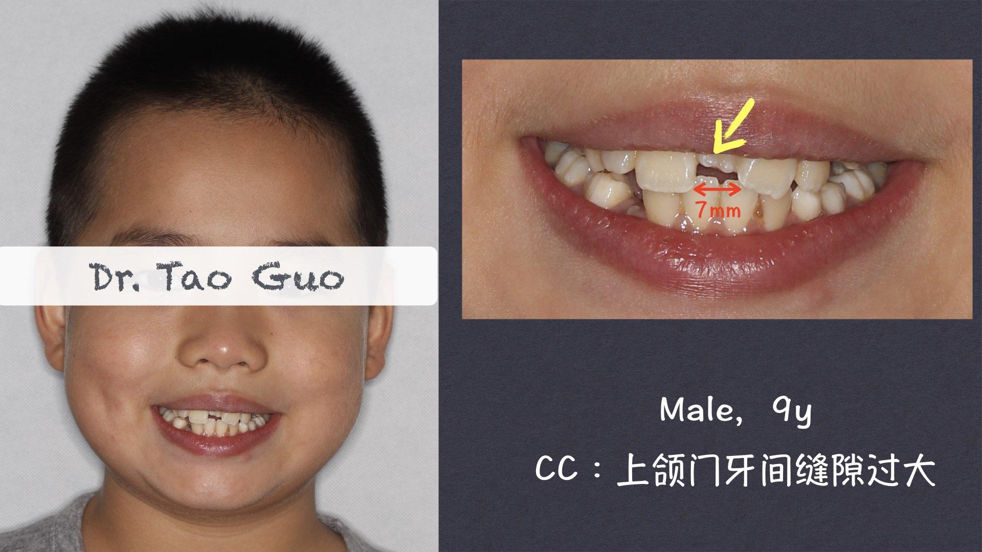 儿童牙缝过大矫正案例 