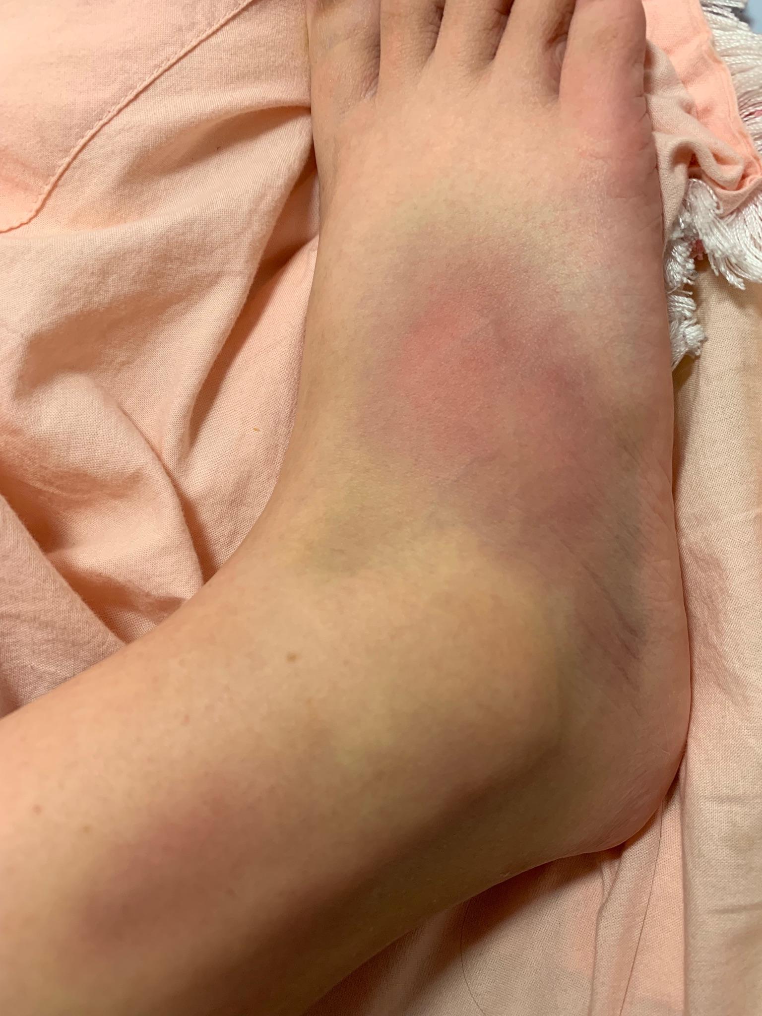 脚扭伤两个月了为什么还是有疼痛感按压之后还会出现淤青