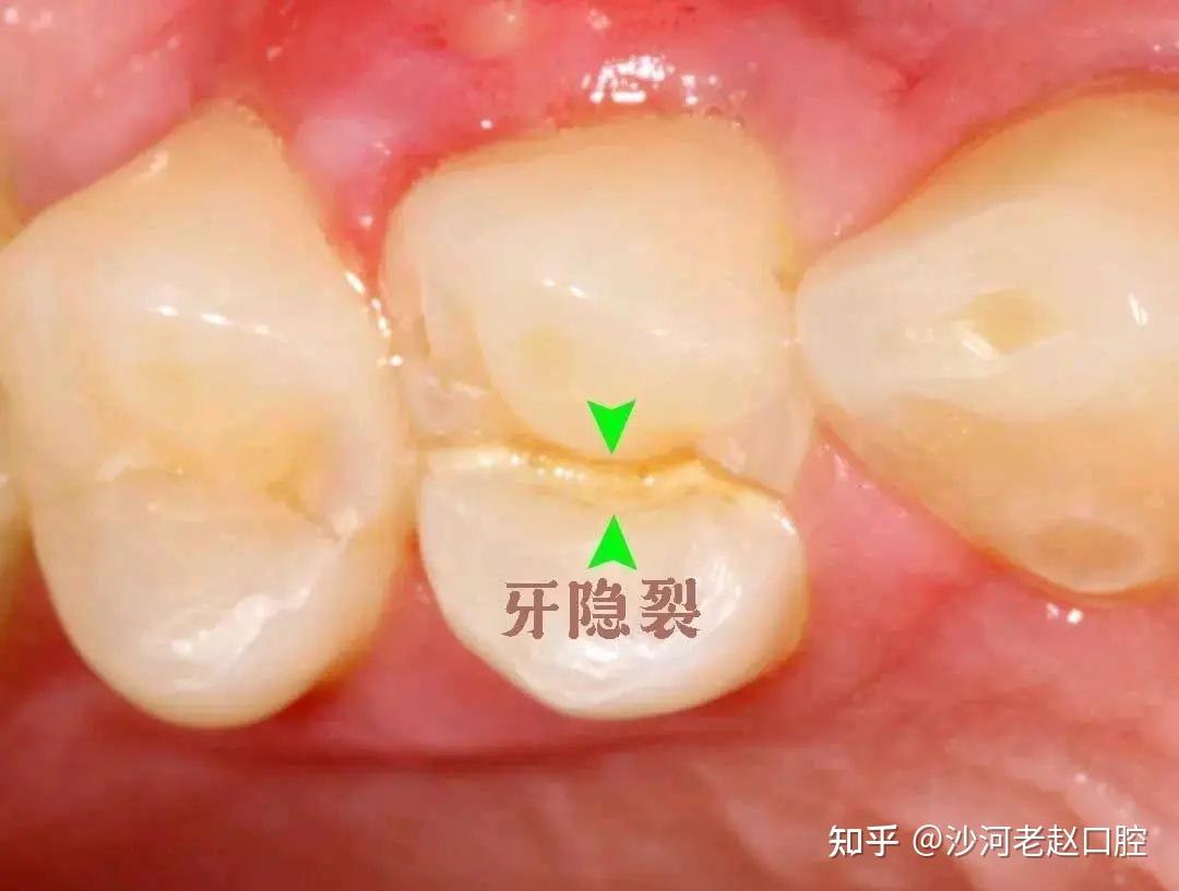 牙齒為什麼有裂縫