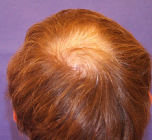 2,为什么男性秃头这么严重?