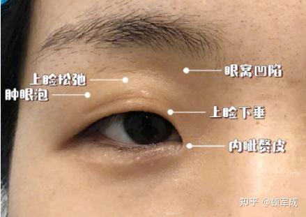 八大眼周衰老问题应该用什么方法来解决 知乎
