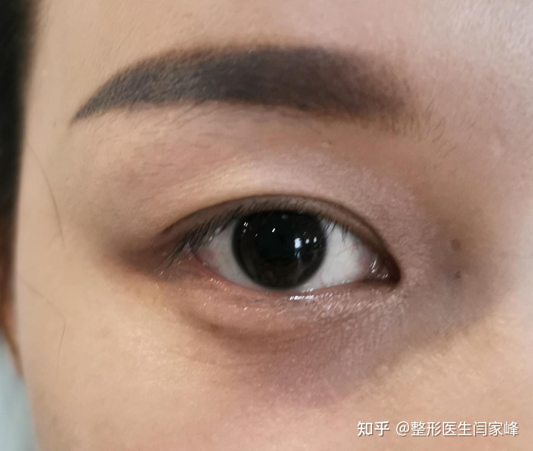 被误诊为"上睑下垂"的"重症肌无力" - 知乎