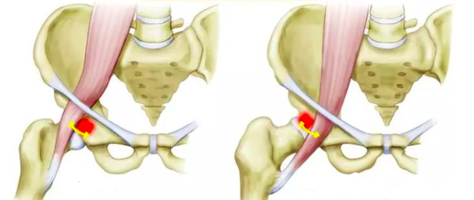 大腿根内侧痛 髂腰肌综合征 知乎 大腿根内侧痛 髂腰肌综合征 知乎