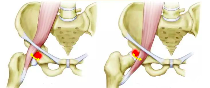大腿根内侧痛 髂腰肌综合征 知乎
