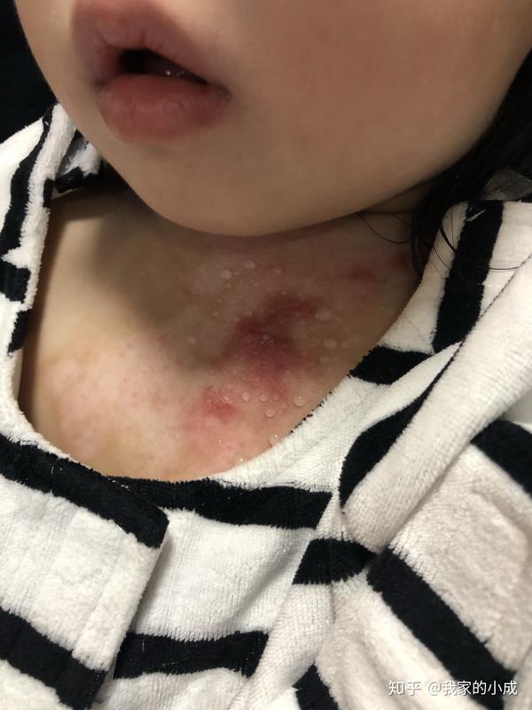 儿童烫伤的急救与康复小成的烫伤日记深二浅二持续更新抗疤痕增生攻略