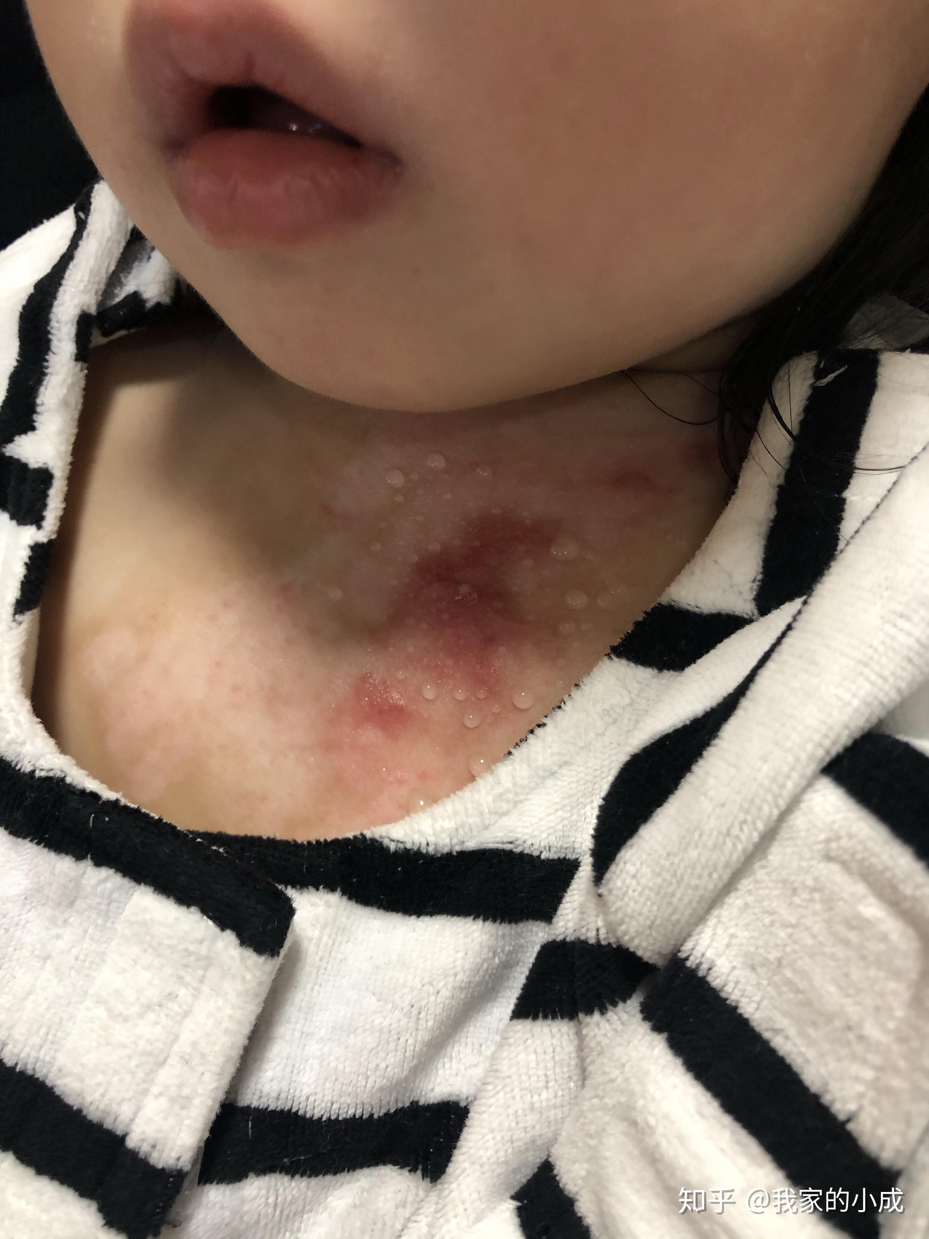 儿童烫伤的急救与康复小成的烫伤日记深二浅二持续更新抗疤痕增生攻略