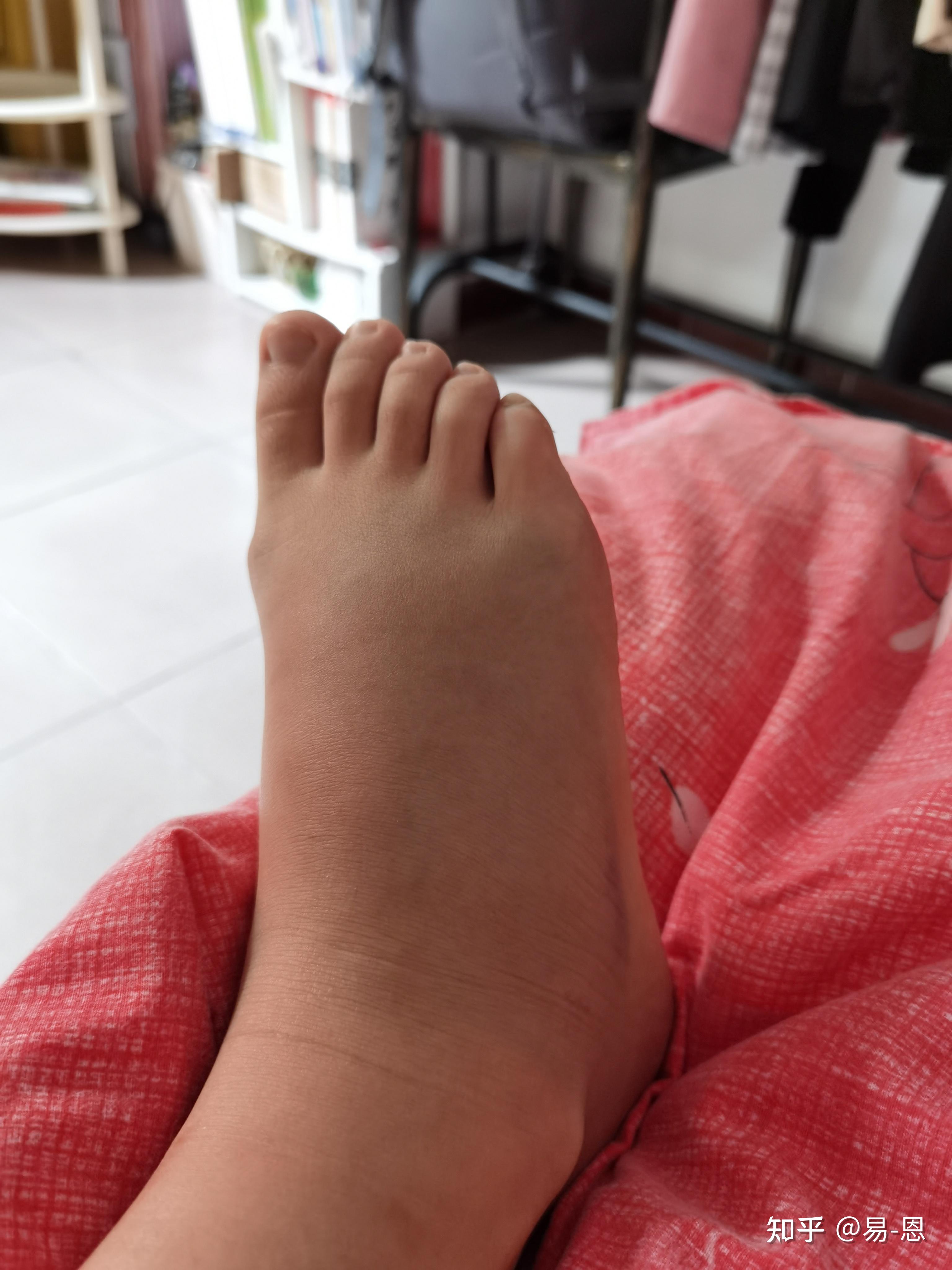 下楼梯脚崴了肿了是什么感觉