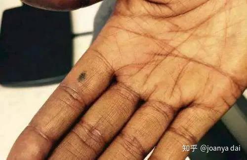 乳腺癌化疗可能产生的副作用及处理办法