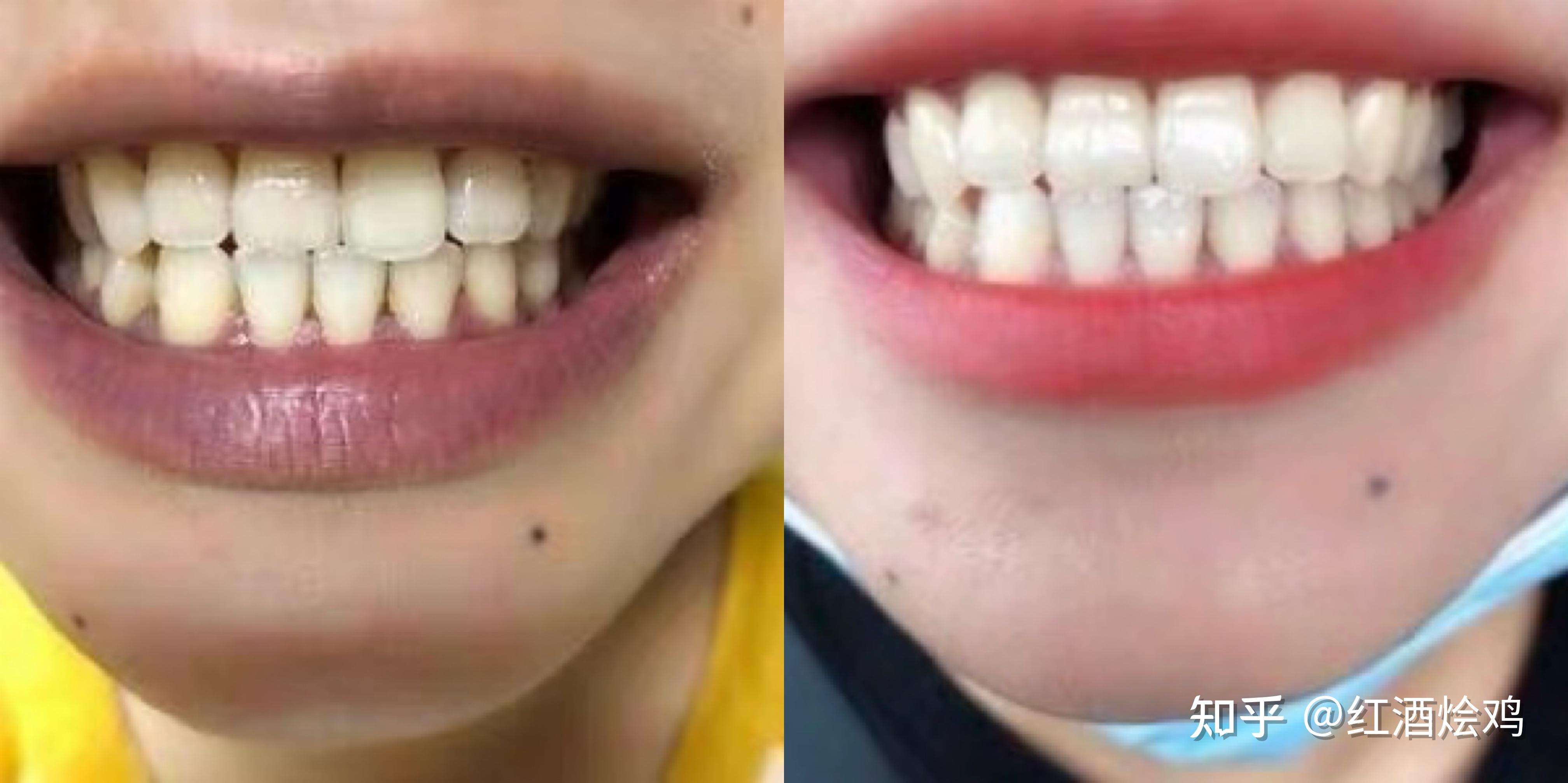 Teeth Whitening | Herndon VA | Cosmetic Dentistry | Philips Zoom!