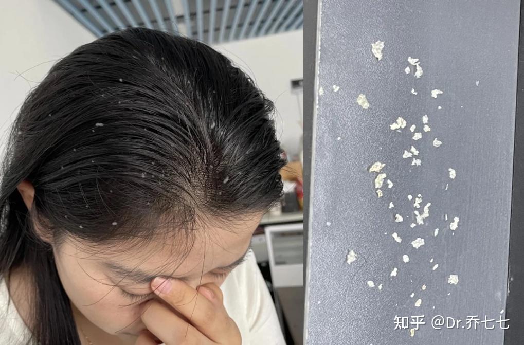 头皮屑特别多,一挠头皮就跟“下雪”一样哗哗掉,医学上有什么可以快速去屑的办法吗? - 知乎