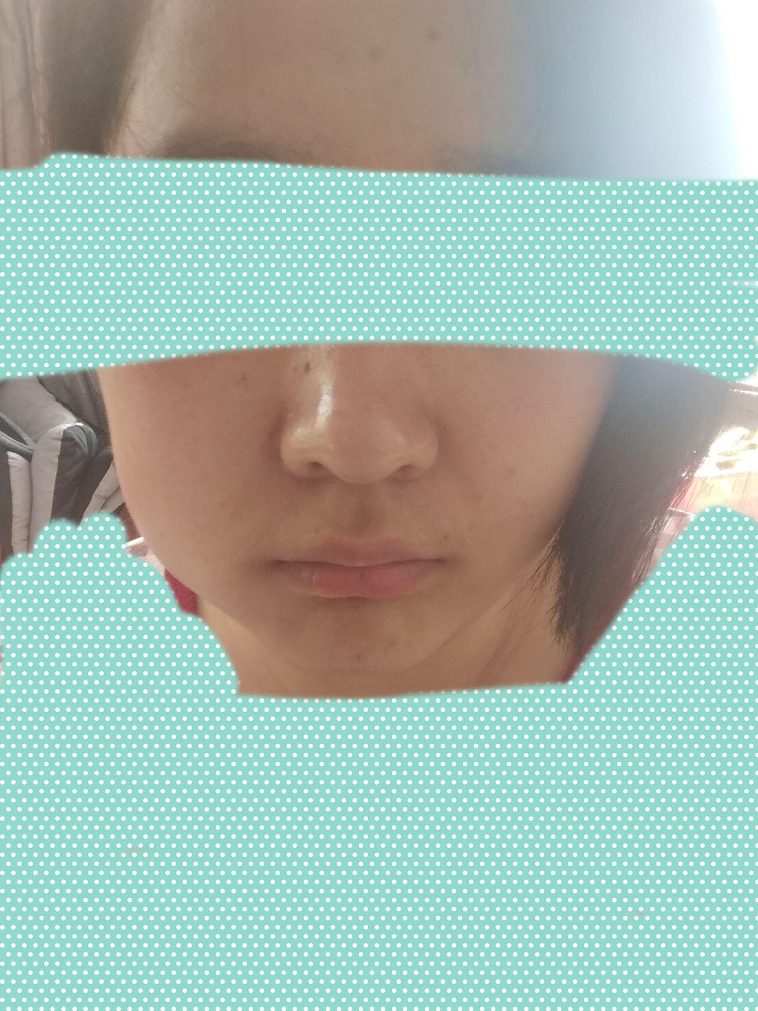 拔完智齿后,不仅牙龈肿痛,连脖子都肿了,咽口水