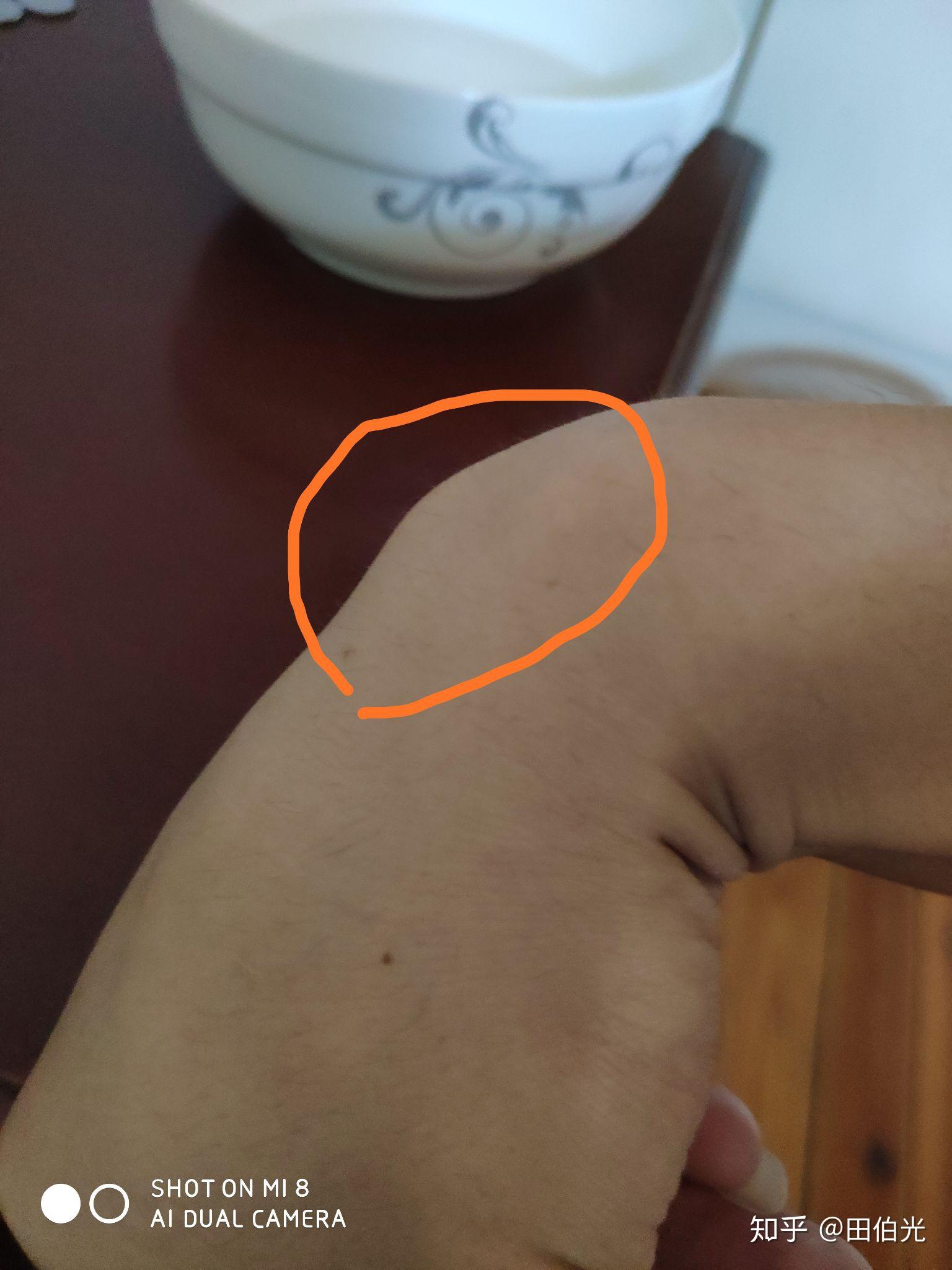 手腕上骨质增生症状?