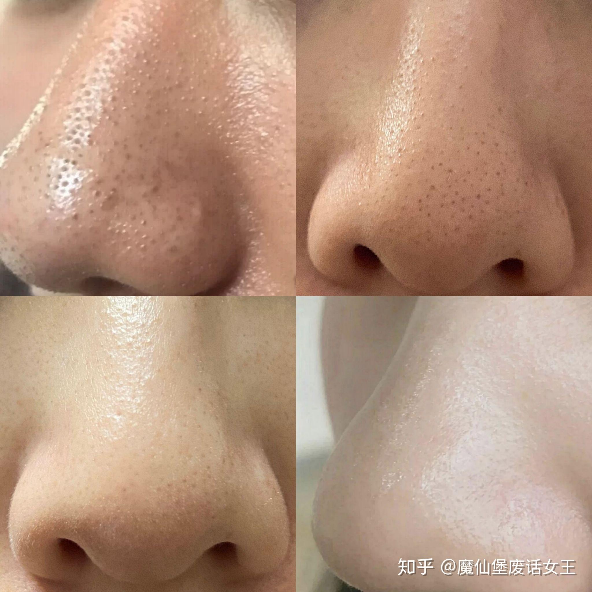 我该拿这个巨大的黑头怎么办