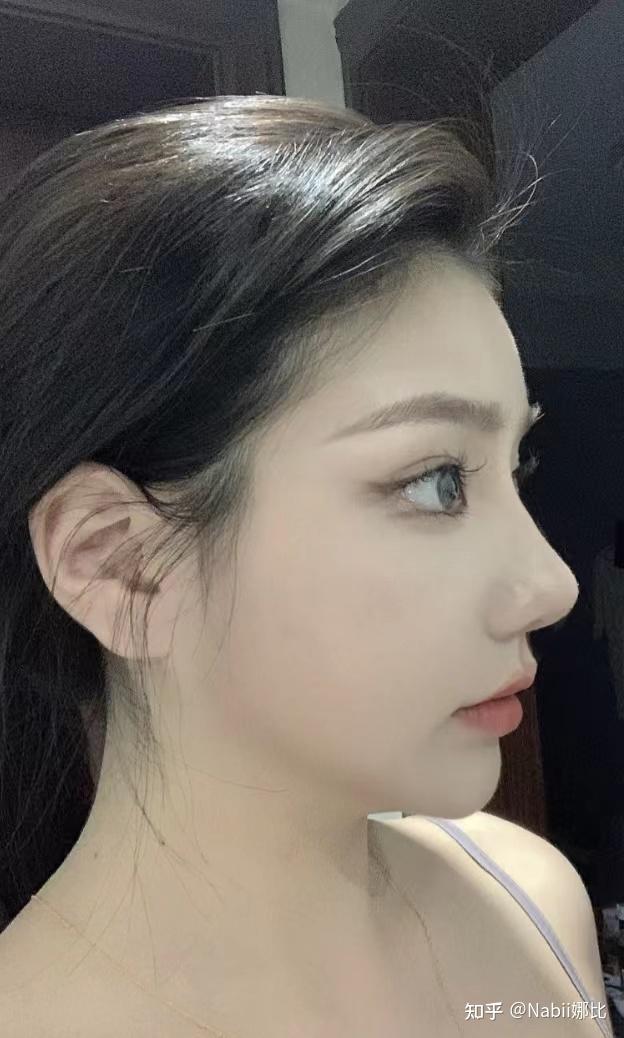 什么叫做妈生款鼻型哪里可以做妈生款自然隆鼻