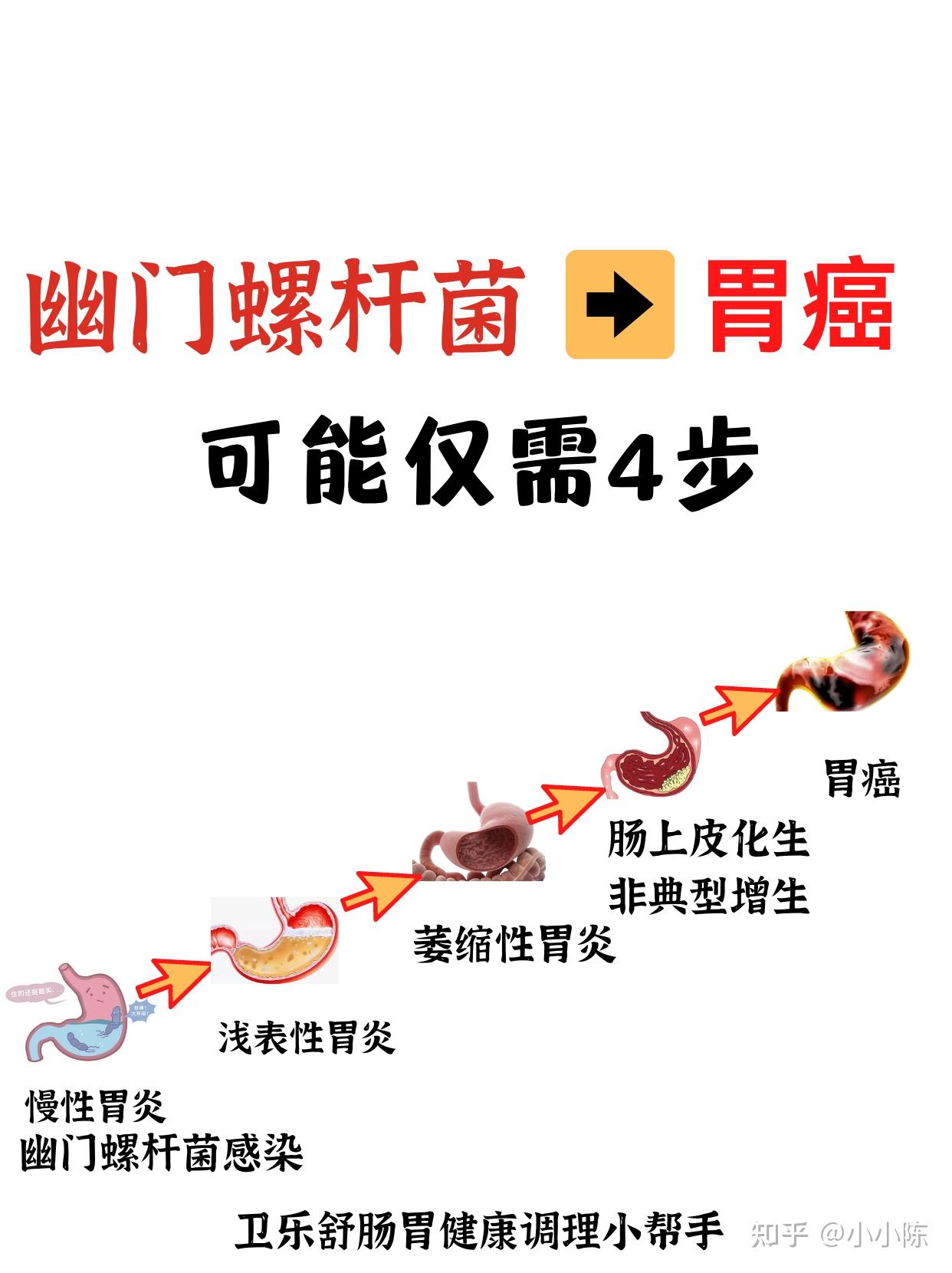从感染幽门螺杆菌到胃癌,也仅需4步 - 知乎
