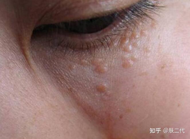 眼睛下边有好多肉色小疙瘩,还有眼皮上,请问是什么,怎么才能去掉?