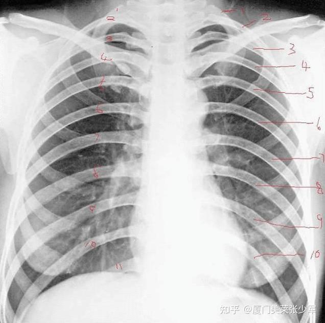 厦门隆鼻科普肋软骨钙化了还能继续用于隆鼻吗