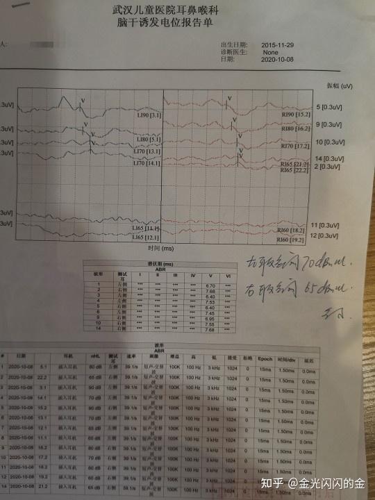 听性脑干反应:click abr左耳反应阈70db nhl,右耳65db nhl耳声发射