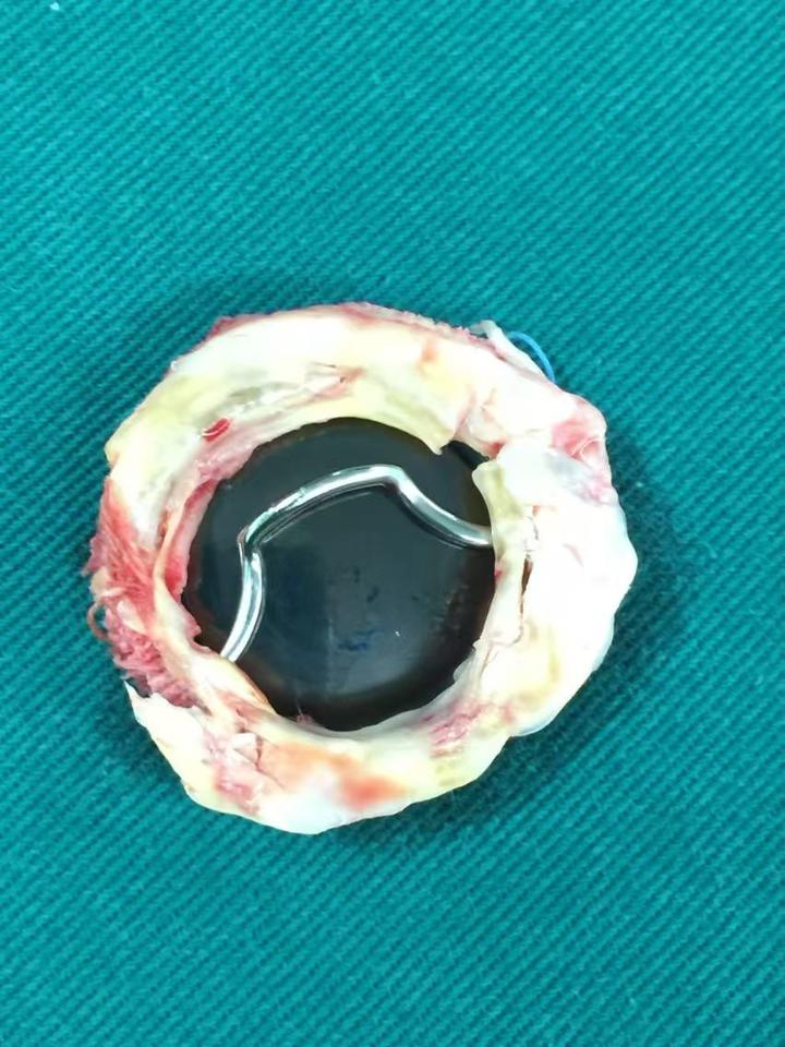 机械瓣置换后为什么还需要再次换瓣 心脏外科李芝医生 ​ 医疗卫生