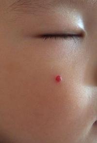 血管瘤系列科普之肉芽肿性血管瘤