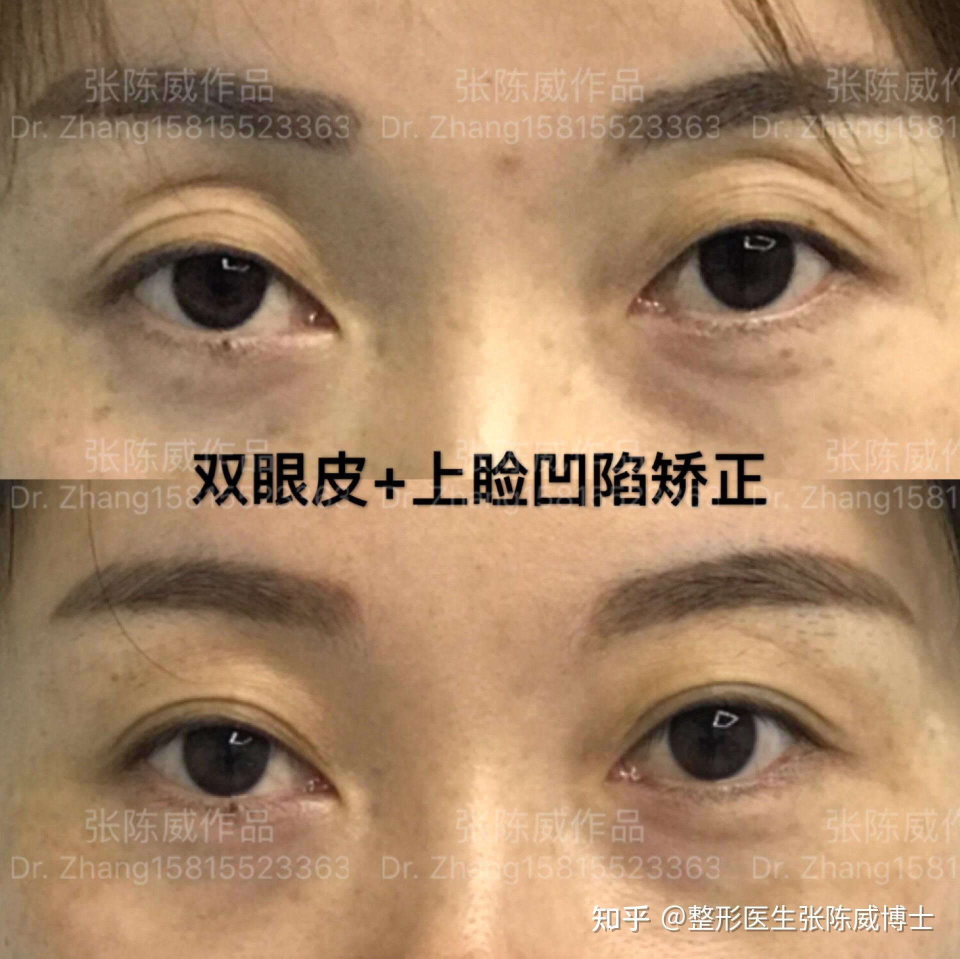 这样算是眼睛凸嘛怎么改善