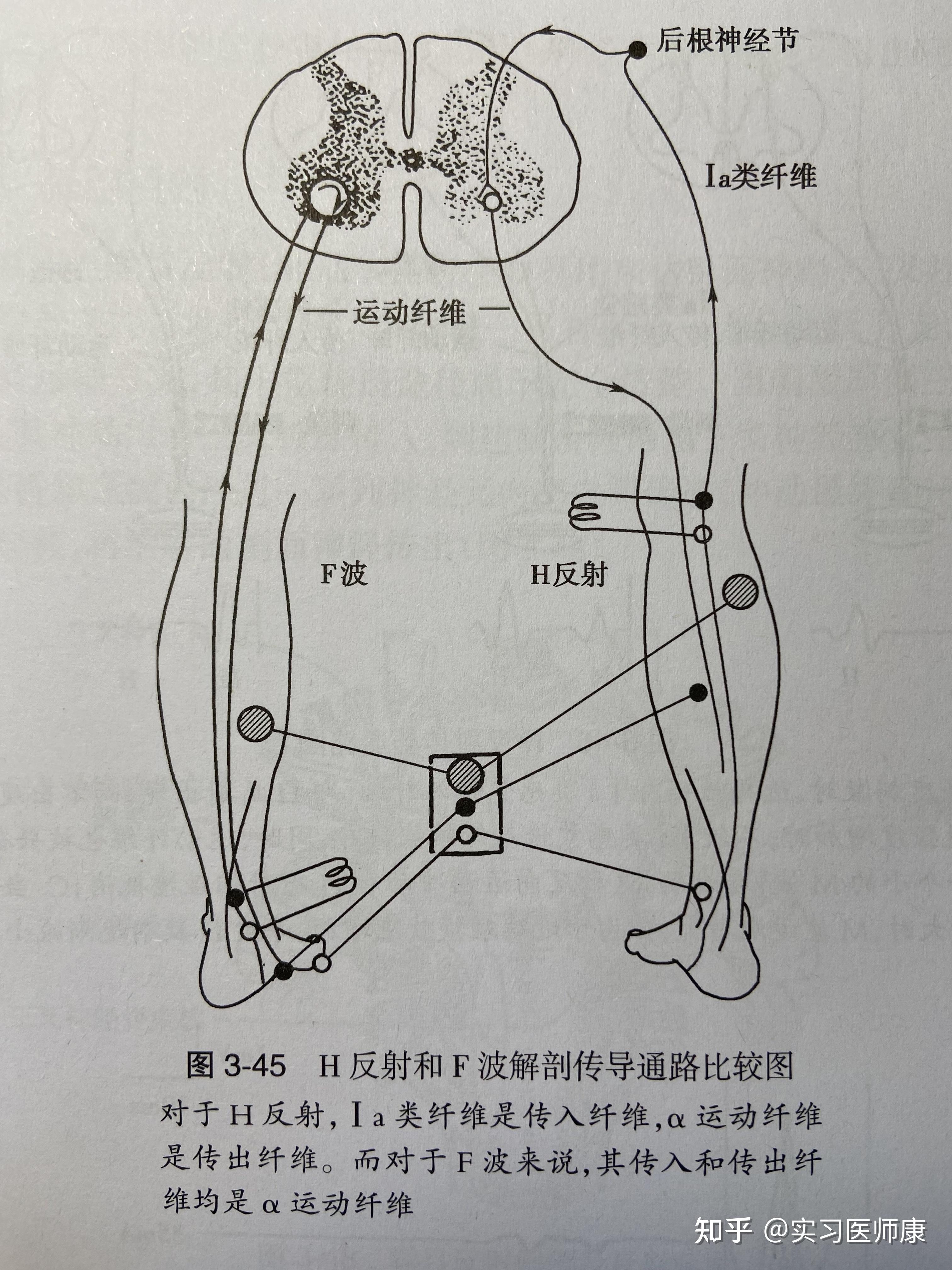 肌电图的h波和m波到底是什么?