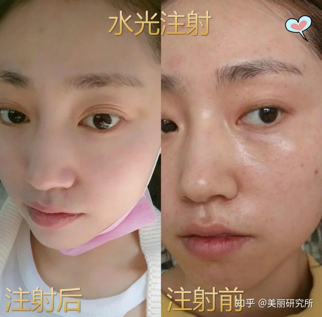 水光针有没有副作用? - 知乎