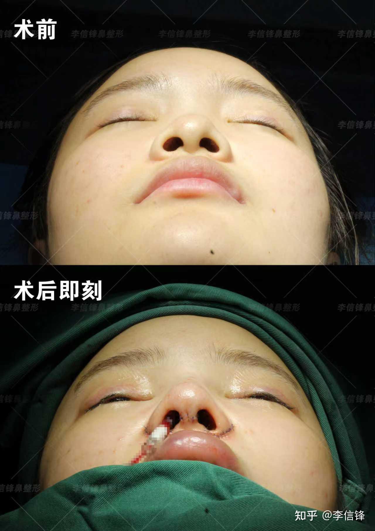 初鼻鼻综合-塌鼻、鼻头圆钝、漏鼻孔,鼻基底凹陷改善,术后即刻对比~ - 知乎