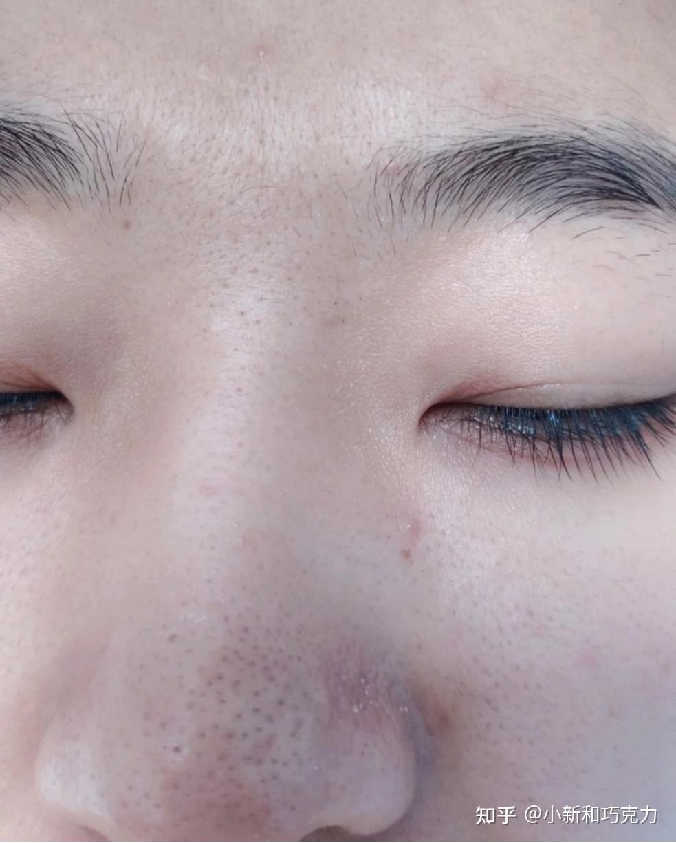 我有一个很严重的草莓鼻,有时候看到满鼻子的黑头,觉得自己的鼻子很丑