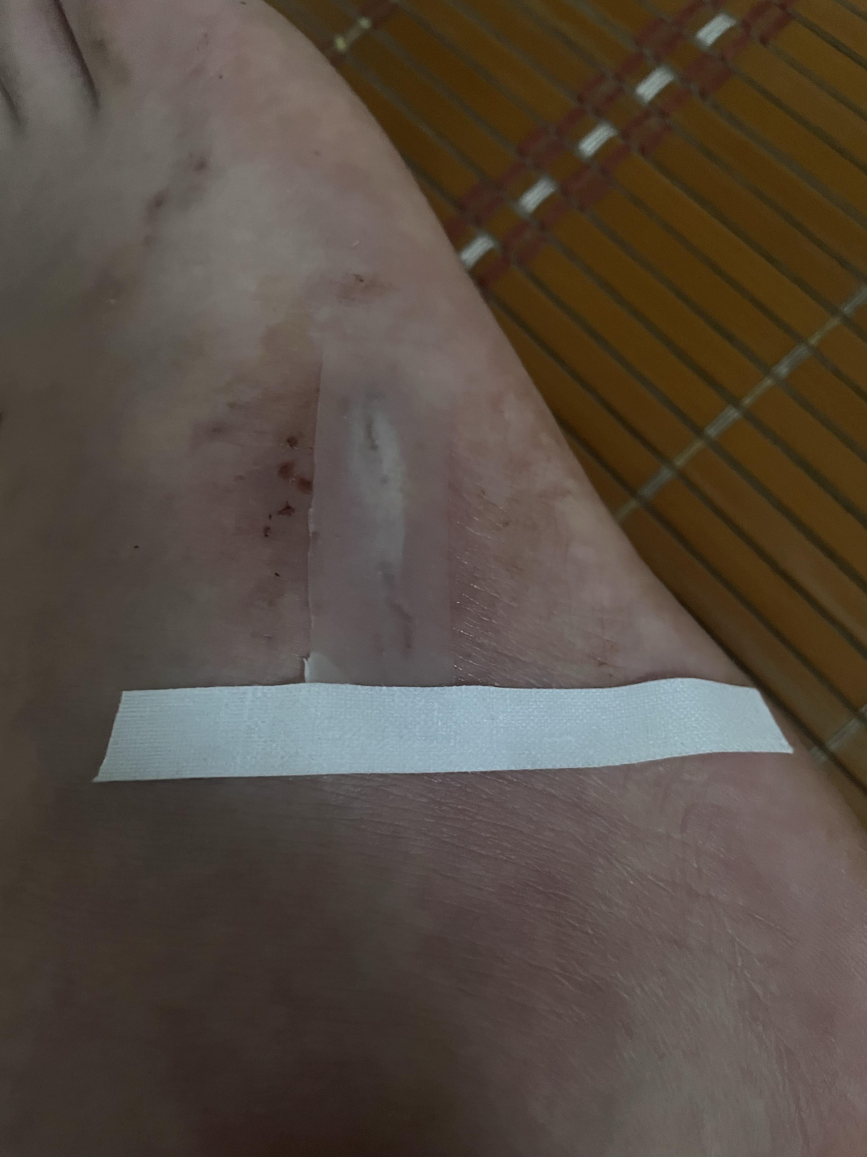湿型愈合-我的亲身体验-擦伤摔伤-膝盖磕伤-治疗办法 - 知乎