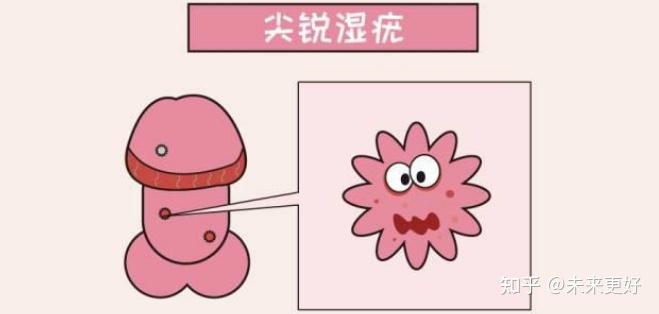 尖锐湿疣间接传染几率有多大? - 知乎