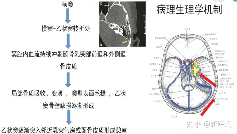 乙状窦沟图片