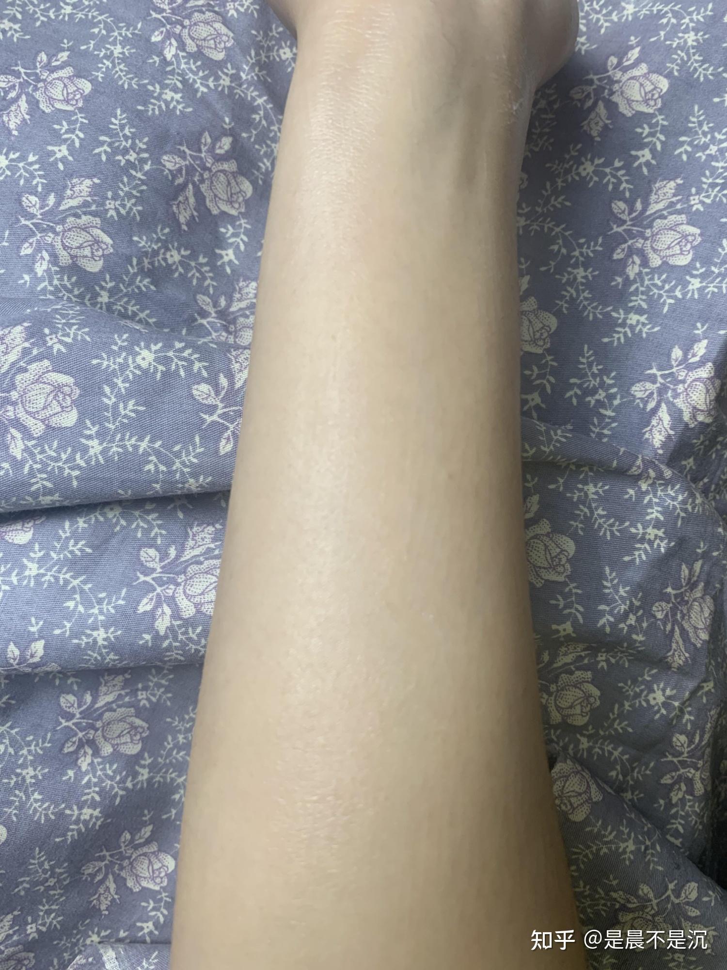 一年四季腿部皮肤都特别干燥(冬季尤其严重)怎么办?