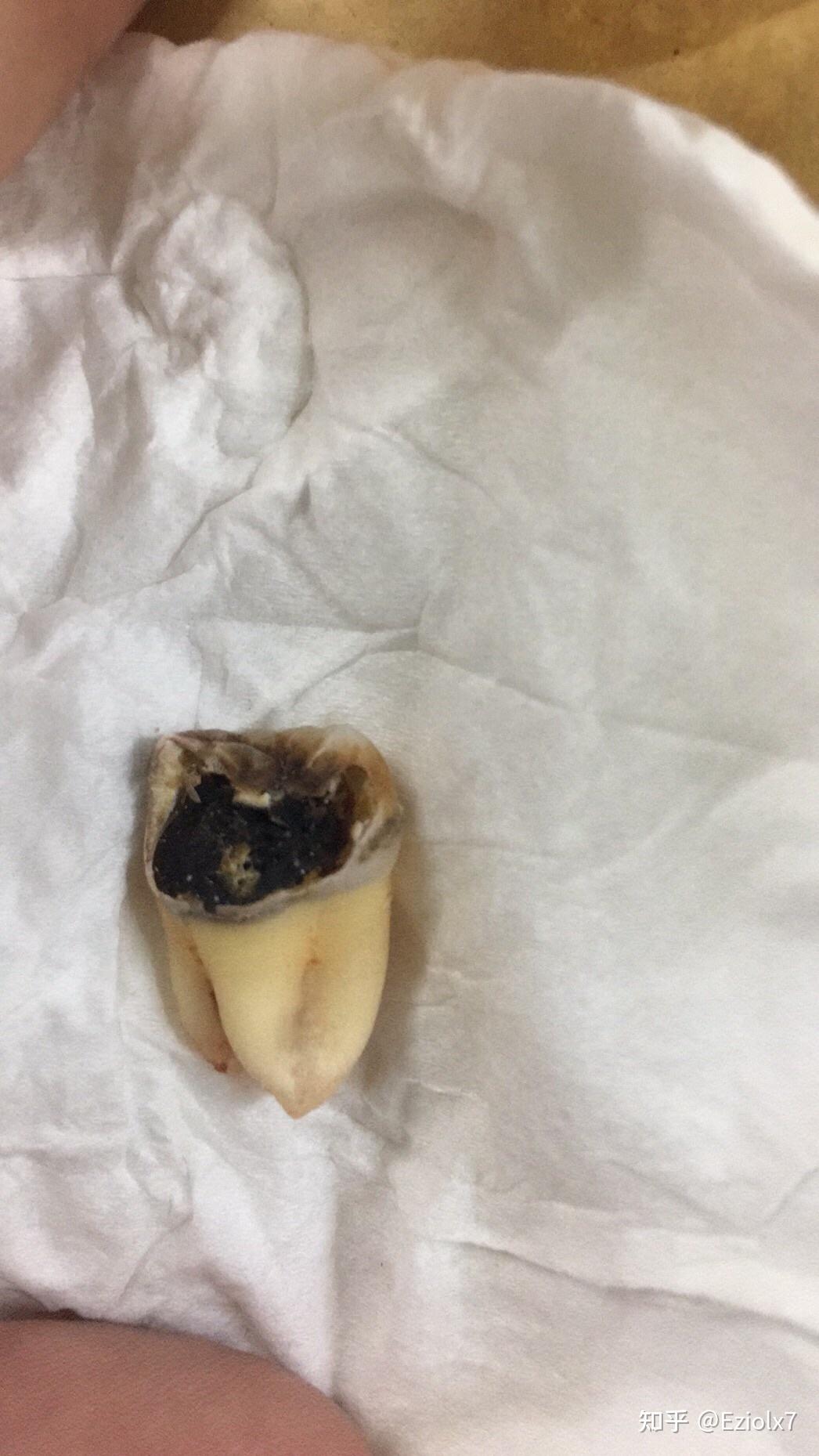 牙齿内部脱落一小块牙齿碎片,然后碎片里面是黑色的,这是什么情况?