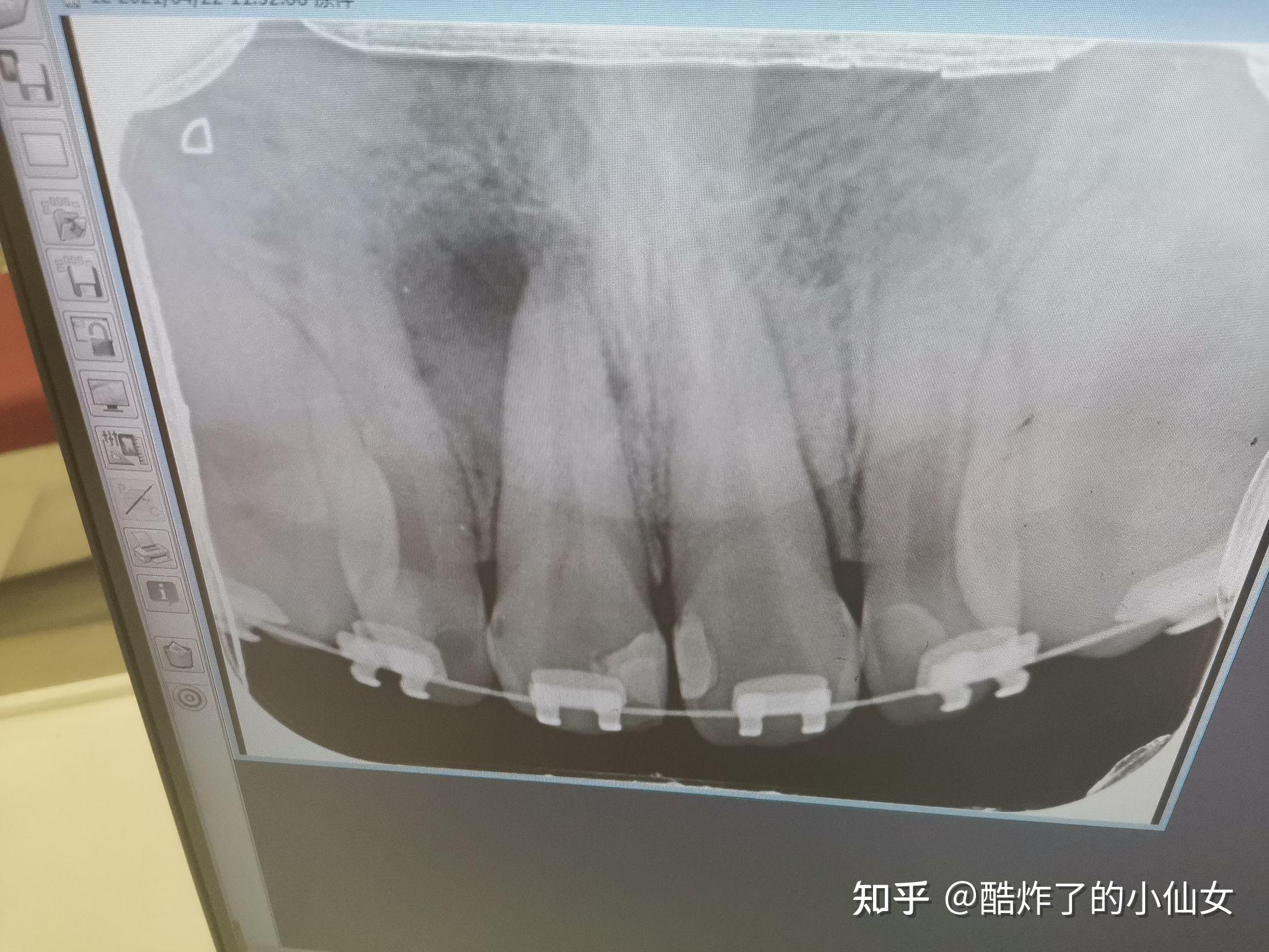 我的四颗门齿疼了几天了去拍片子照的牙齿根部有阴影牙医说我得了炎症