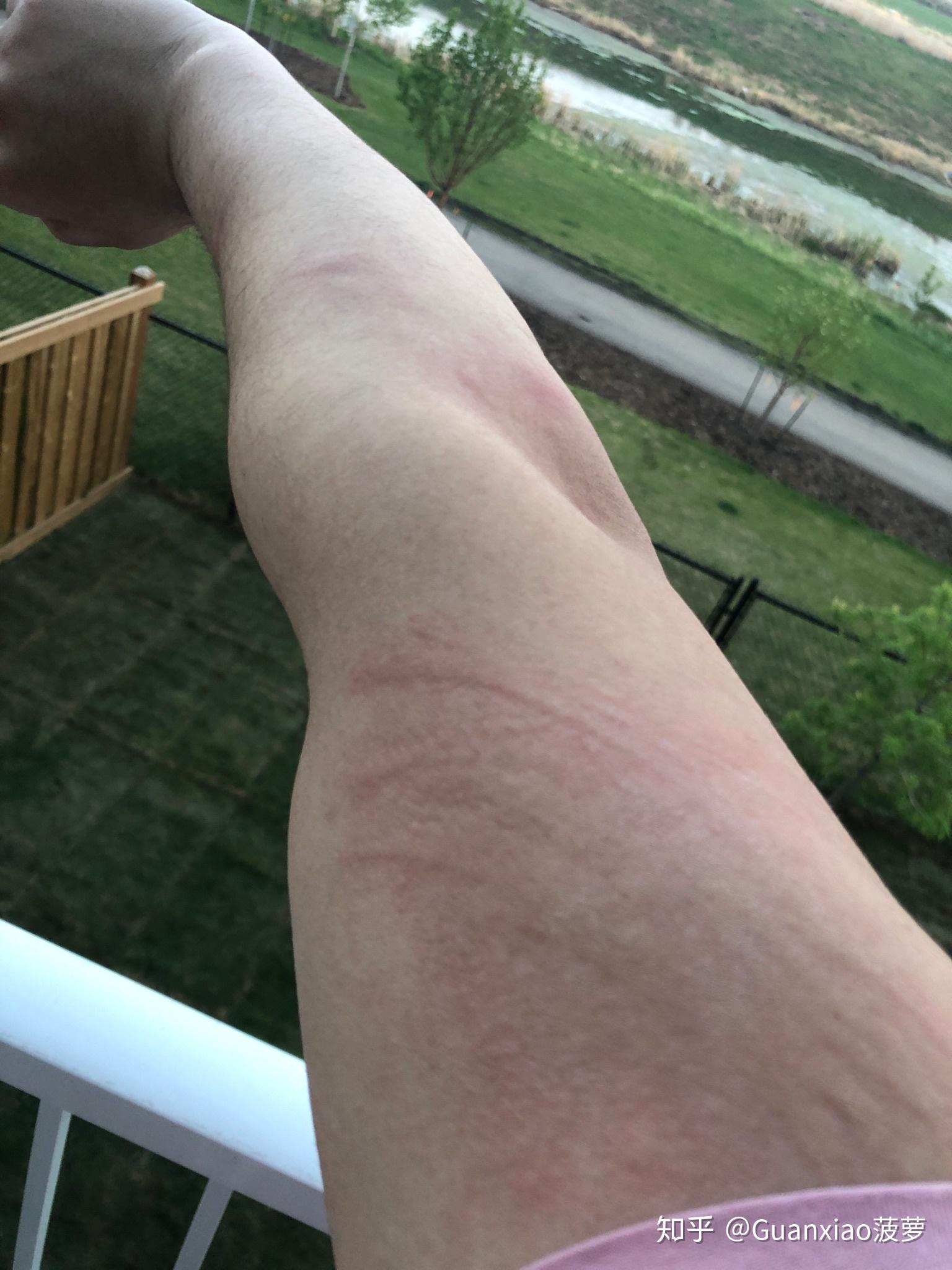 人工荨麻疹(皮肤划痕症)的原理是什么?有治疗的必要么?