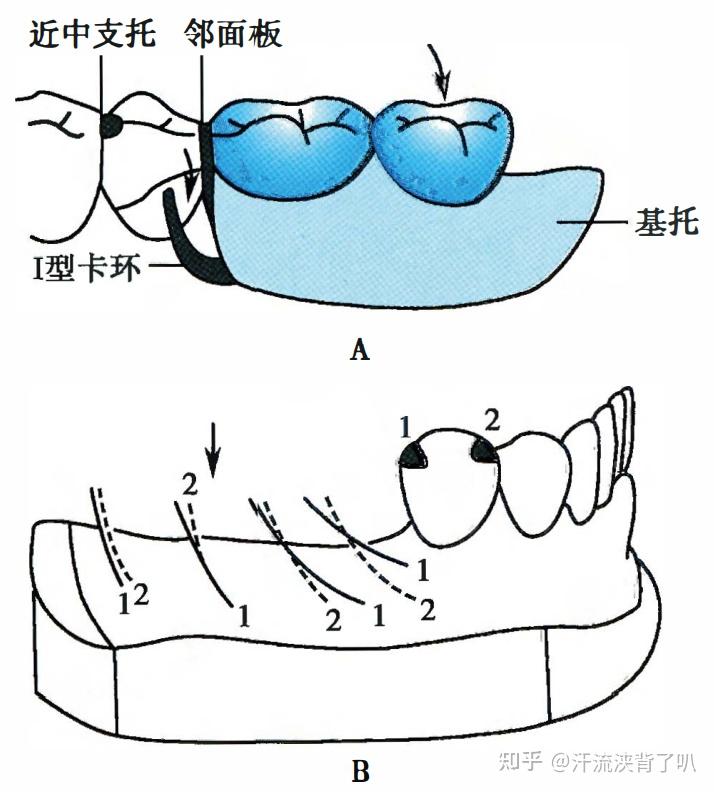 每天一个知识点:rpi卡环组的优点