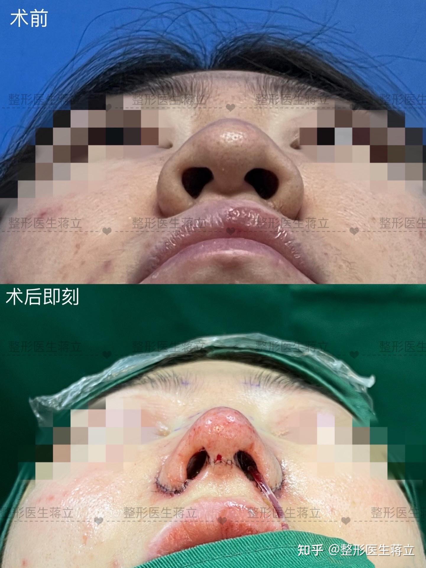 【鼻翼外扩以及其分型①】整形医生蒋立