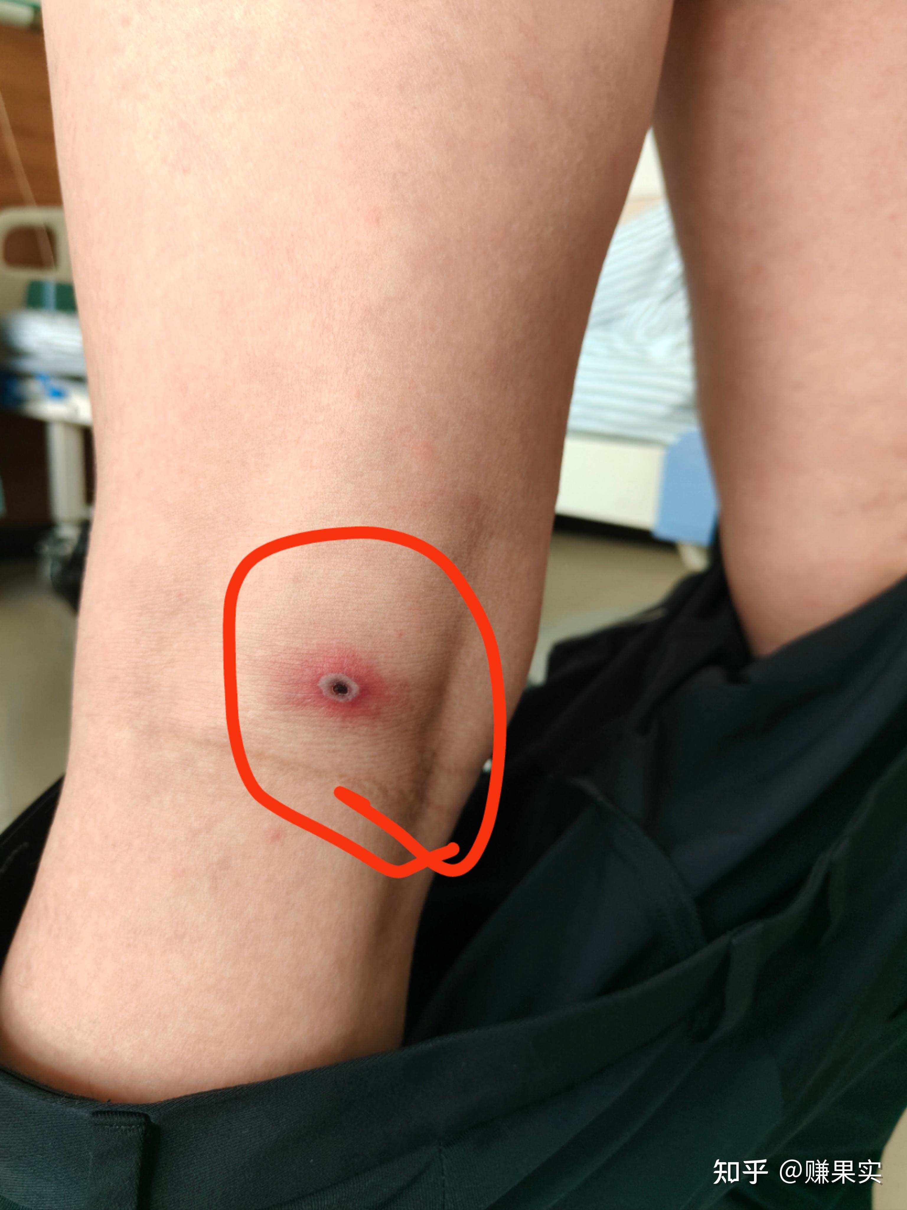 恙虫叮咬会导致人体多器官功能衰竭而亡,这种说法是真实的吗?