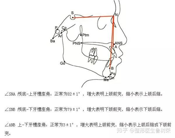 x线测量 x线头影测量显示sna角小于正常范围,snb角一般正常,anb角