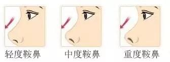 鞍鼻怎么办 - 知乎
